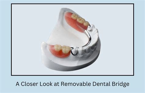 A Closer Look At Removable Dental Bridge Features Benefits And