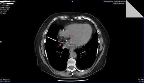 Lipomatous Hypertrophy Of The Atrial Septum A Benign Heart Anomaly