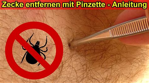 Zecke Entfernen Mit Pinzette Ohne Zange Anleitung Zecken Rausmachen