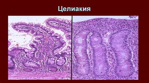 Целиакия
