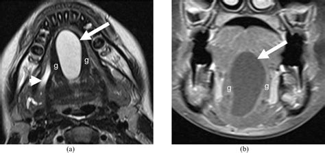 29 Year Old Female With A Dermoid Cyst In The Root Of Tongue A Axial