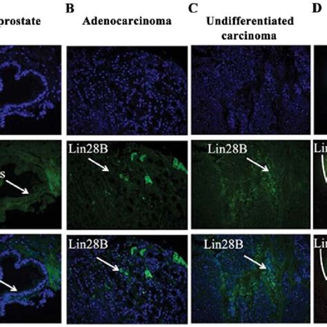 Lin B And C Myc Expression In The Prostate Cancer Cell Lines Lncap And