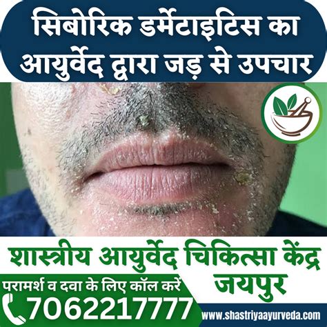 Seborrheic Dermatitis Treatment at Rs 1000/session in Jaipur | ID ...