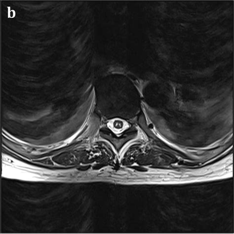 Thoracic Spinal Cord Mri Sagittal T Weighted Mri Shows Signal