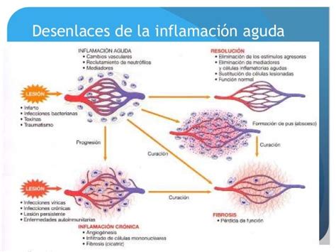 Inflamación Aguda Patología