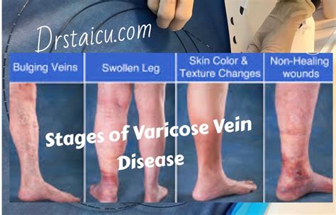 Vascular And Varicose Veins