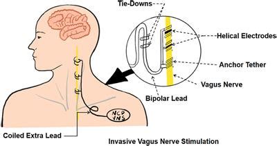 Frontiers Research Advances In The Application Of Vagus Nerve