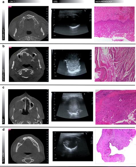 US characteristics of the lesions. a Simple cyst, b complex cyst, c ...