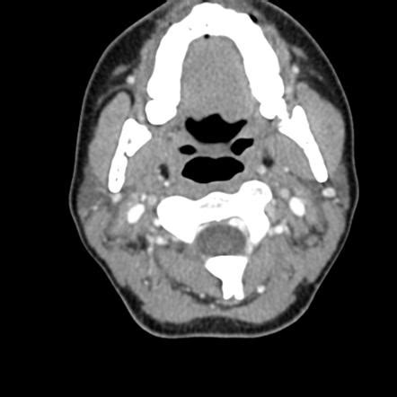 Soft Tissue Neck CT Scan