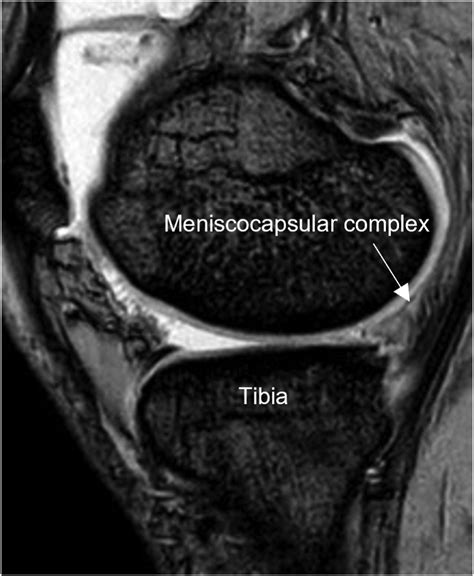 Arthroscopic All-Suture Anchor Technique for Unstable Ramp Lesions with