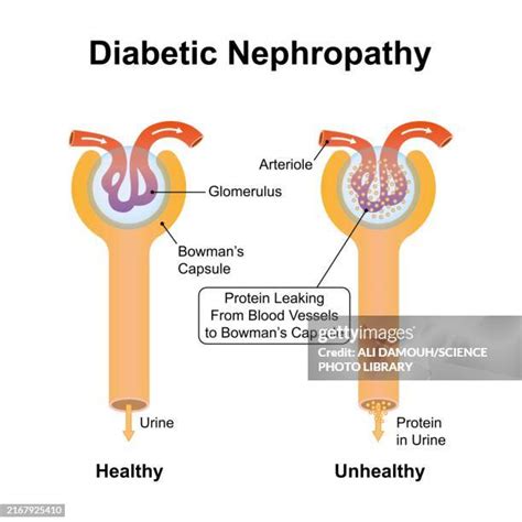 206 Diabetic Nephropathy Stock Photos High Res Pictures And Images