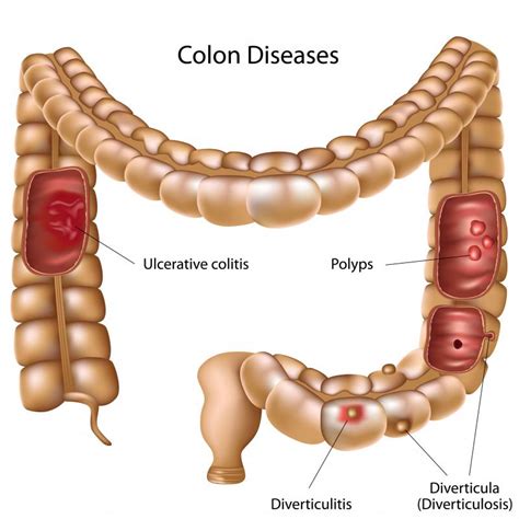 What are the Different Types of Intestinal Disease?