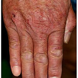 Clinical presentation. Gottron's sign on the dorsum of the hands were... | Download Scientific ...