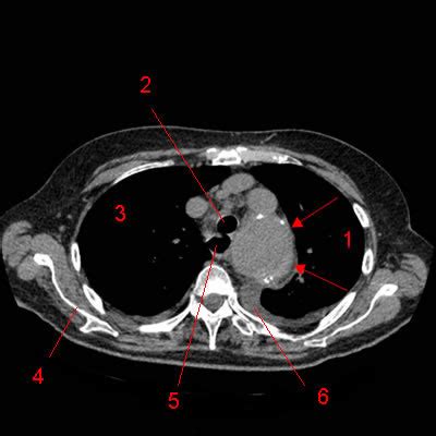 An Vrisme Sacciforme De L Aorte Thoracique