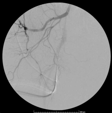 Prostate Artery Embolization Procedure IR Treatment For BPH