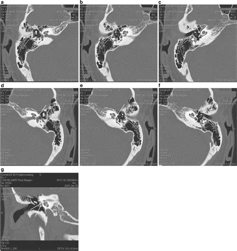 Otosclerosis Radiology Key