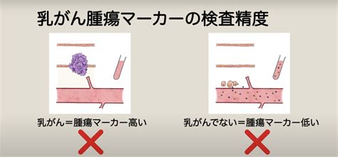 腫瘍マーカーがんマーカーって何？｜乳がん大事典｜bc Tube｜複数人の乳腺科医による制作・監修