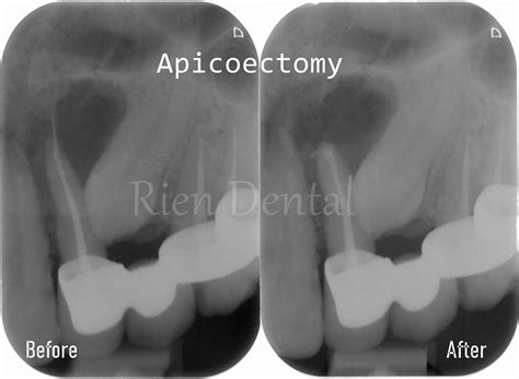 Apicoectomy Root Canal Surgery