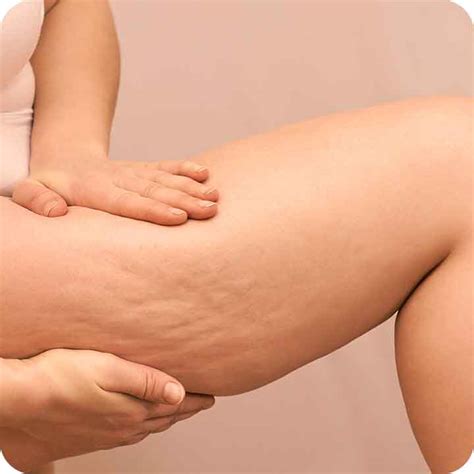 Lipedema O Que Sintomas E Como Tratar Recomendado Lucox Cl