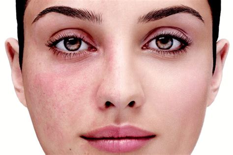 What Is The Difference Between Rosacea And Acne Laser Hair Removal