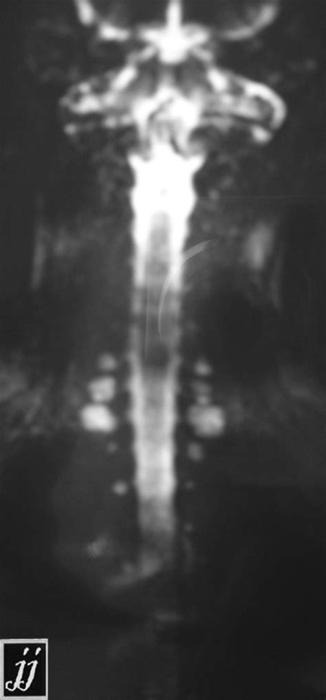 Lateral Meningocele Radiopaedia