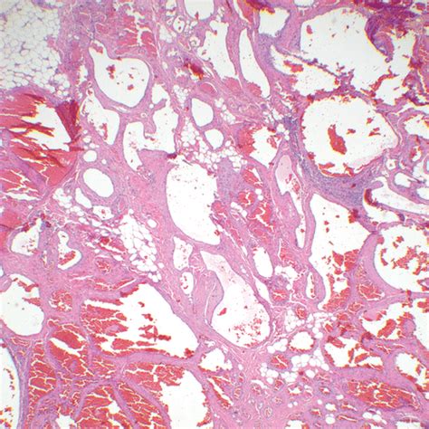 Revised Classification Of Vascular Lesions From The International