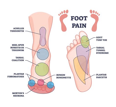 Foot Bursitis: Causes, Symptoms and Treatment