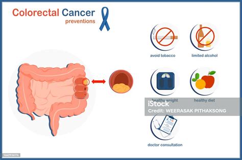 Colorectal Cancer Prevention Stock Illustration - Download Image Now ...