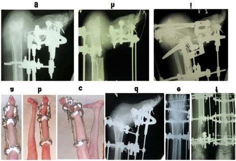 Stage After Obtaining Ankle Arthrodesis A E Distraction After