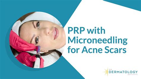 Prp With Microneedling For Acne Scars Youtube