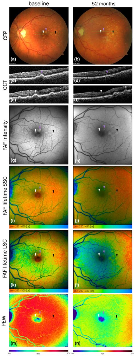 Lipofuscin Its Origin Properties And Contribution To Retinal