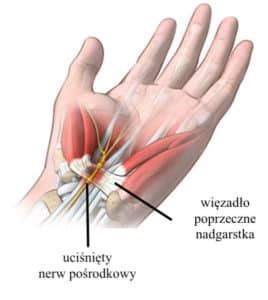 Zespół cieśni nadgarstka Czy zawsze potrzebna jest operacja