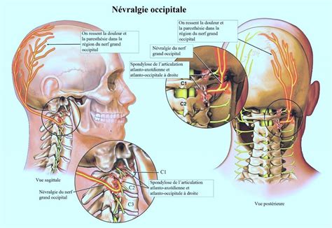 Arthrose cervicale tout savoir sur ce phénomène