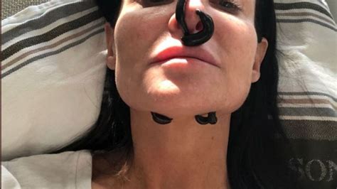 Botched Nose Jobs