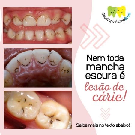 Perdido Ervas Volatilidade Manchas Nos Dentes Como Tirar Qualquer Um