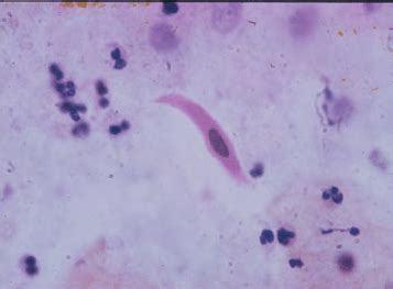 A) Schistosoma ova terminal spine in urine. B) Squamous cell carcinoma ...