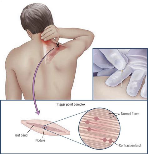 Trigger Point Dry Needling Pelvic Health Physical Therapy