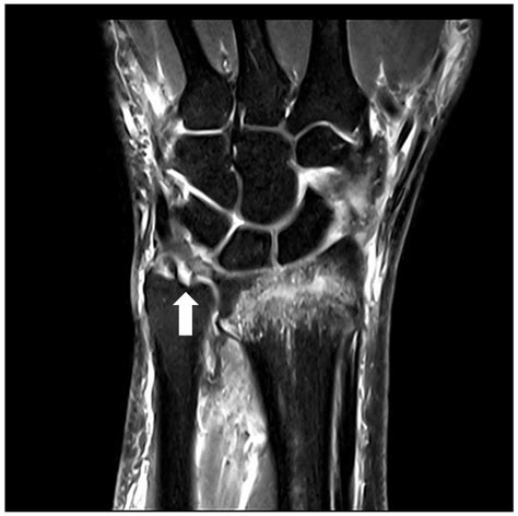 JCM Free Full Text Fracture Severity And Triangular Fibrocartilage