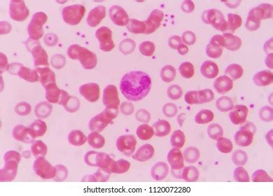 Rouleaux Formation On Blood Smear Foto De Stock Shutterstock