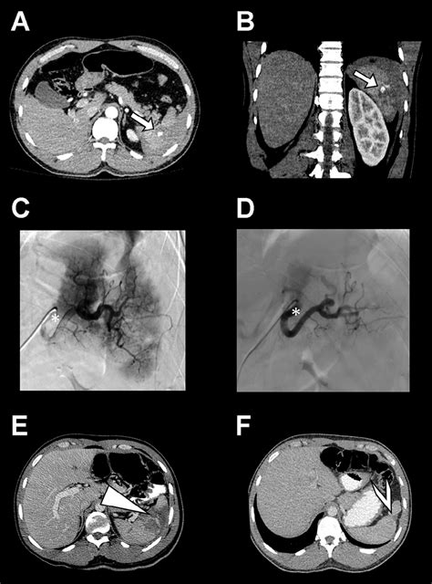 Maging Examples Of Splenic Hemorrhage And Angiography This Figure Download Scientific Diagram