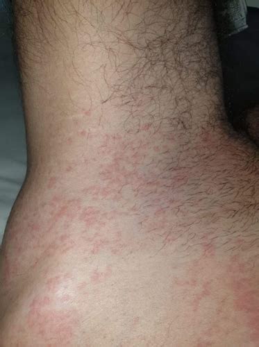 Scabies Rash On Neck Porn Sex Picture