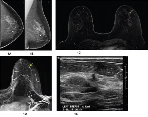 Breast Mri Screening For The Clinician Evolution To Current Evidence