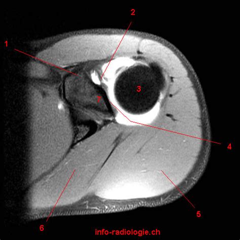 Arthro Irm De L Paule Anatomie