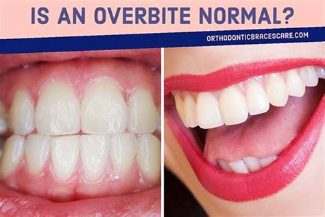 Is An Overbite Normal? How To Diagnose It? - Orthodontic Braces Care