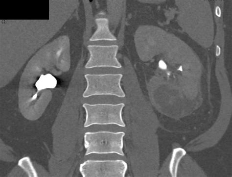 Acute Pyelonephritis With Abscess Kidney Case Studies Ctisus Ct