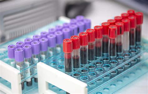 Study discovers how new blood serum test detect neurodegenerative ...