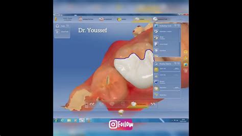 Onlay Indirect Restoration Cerec Cadcam Youtube