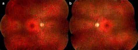 Autoimmune Retinopathy A Review International Journal Of Retina And Vitreous Full Text