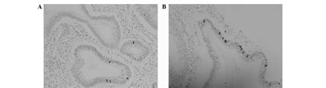 Immunohistochemical Staining Of Cd133 Expression In Different Tnm