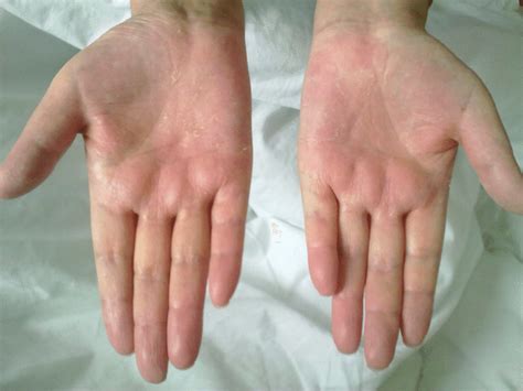 Palmar Erythema Liver Disease